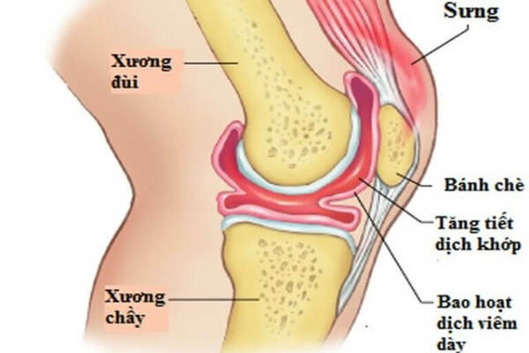 Cấu tạo và vị trí của khớp gối khiến bộ phận này dễ bị viêm nhiễm