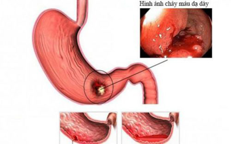 Biến chứng xuất huyết dạ dày