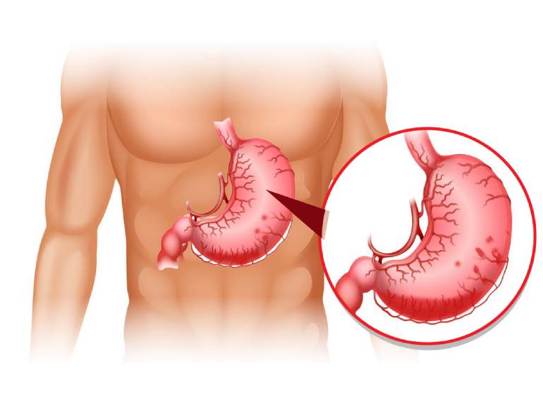 Chảy máu dạ dày có chữa được không là thắc mắc chung của nhiều người