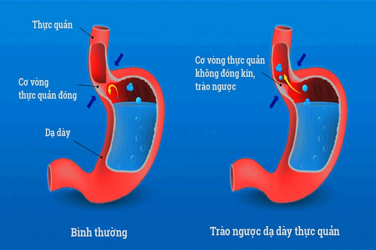 chế độ ăn của người trào ngược dạ dày