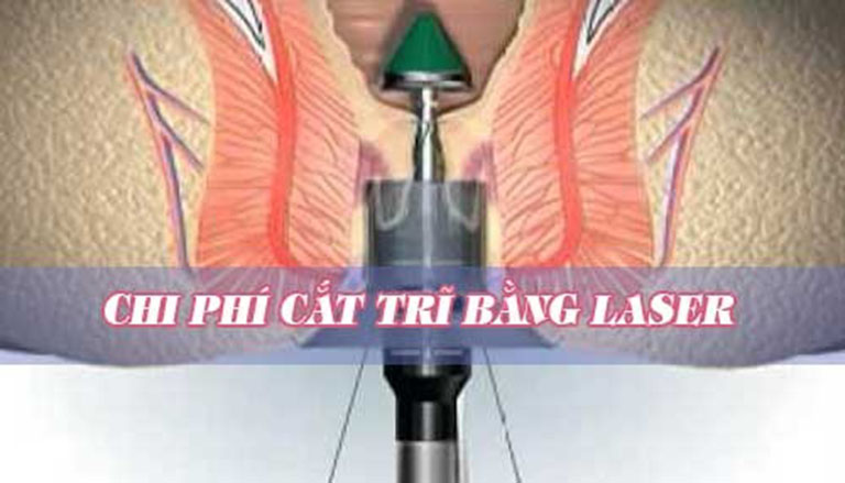 Chi phí cắt trĩ bằng tia laser còn phụ thuộc vào nhiều yếu tố khác nhau