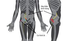 chữa đau dây thần kinh tọa bằng thuốc nam