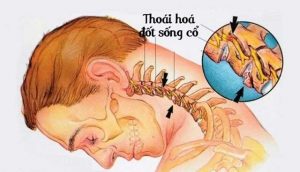 chữa thoái hóa đốt sống cổ bằng thuốc nam