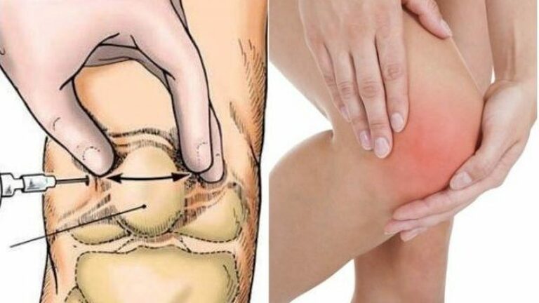 cách thức chữa tràn dịch khớp gối của Tây y