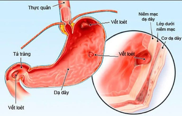 Dạ dày và bao tử giống hay khác nhau?