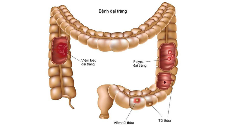 đau bụng đi ngoài ra máu