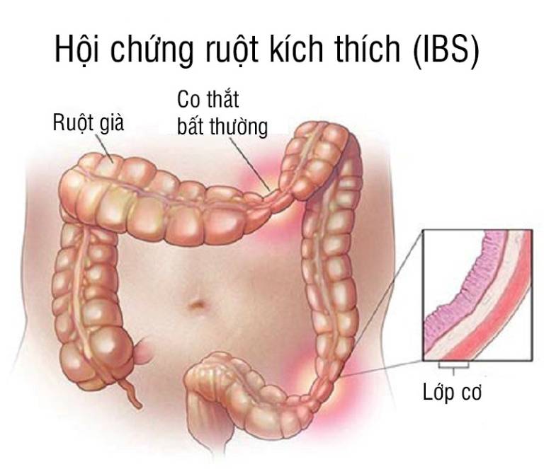 Hội chứng ruột kích thích