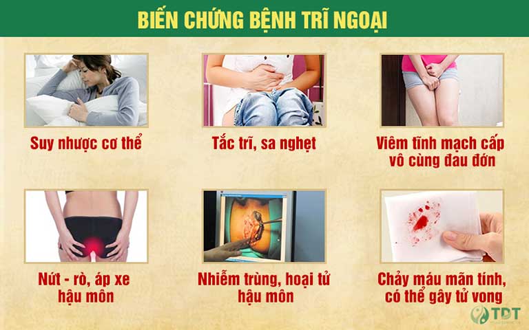 Một số biến chứng nguy hiểm của bệnh trĩ ngoại