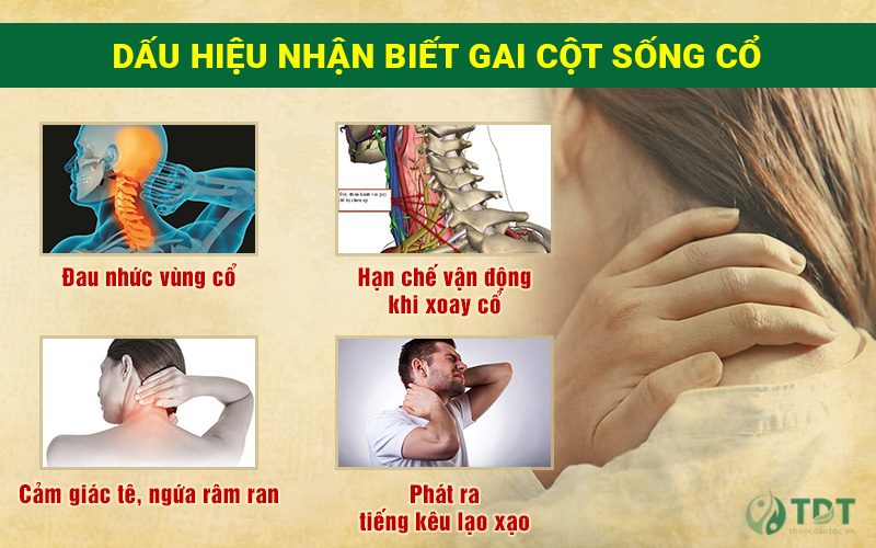 triệu chứng nhận biết gai cột sống cổ