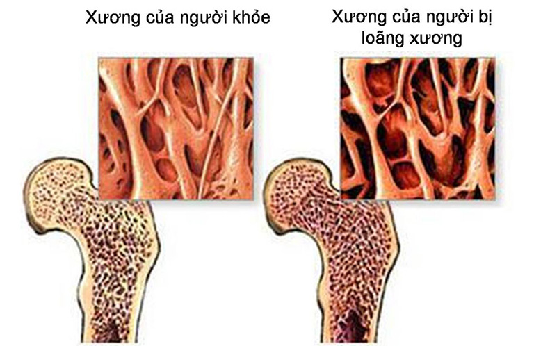 dấu hiệu loãng xương