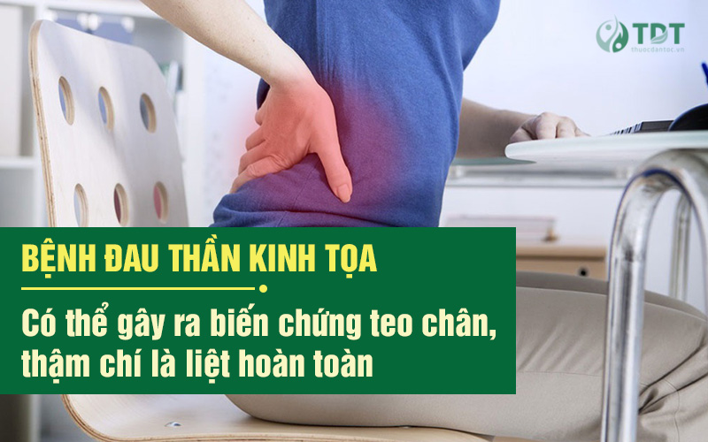 Đau thần kinh tọa có thể biến chứng nguy hiểm