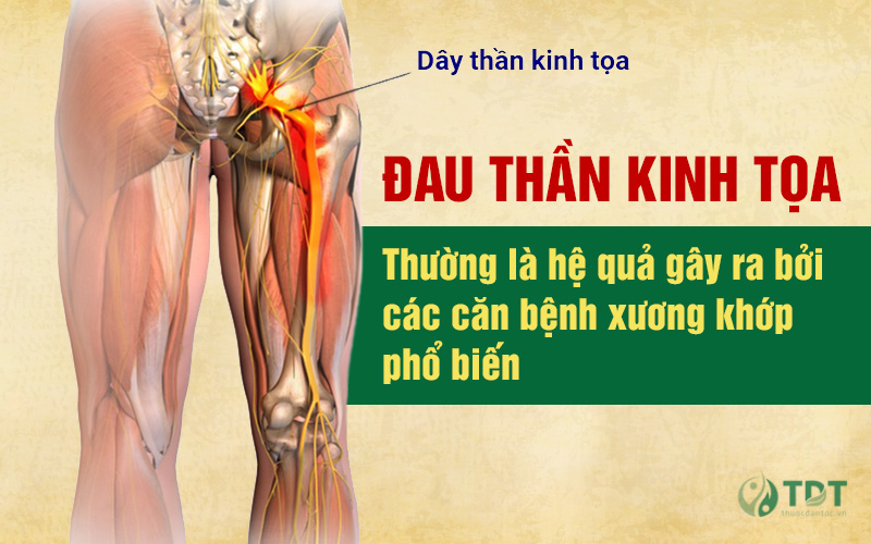 Nguyên nhân phổ biến gây đau thần kinh tọa là do các bệnh xương khớp