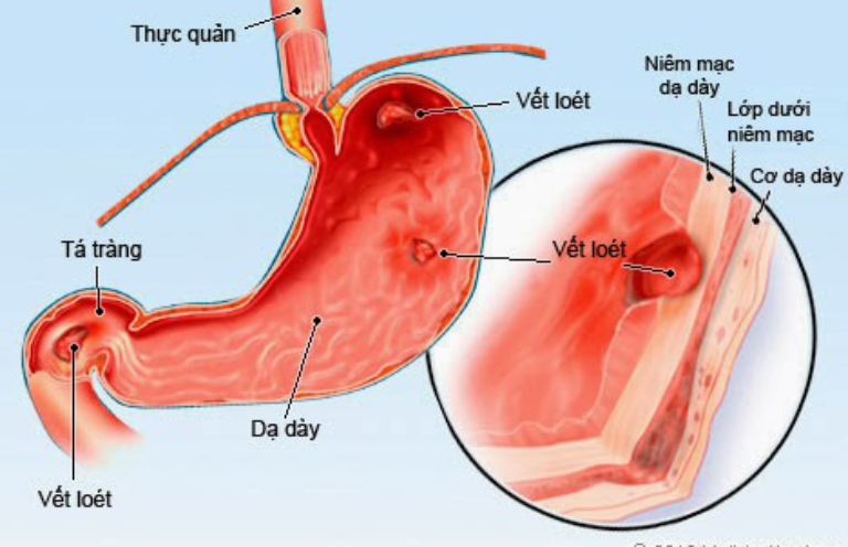 Viêm dạ dày cấp tính