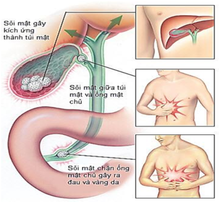 Ống mật bị tắc do giun