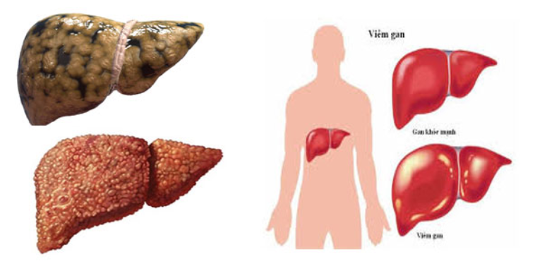 Đau thượng vị còn là dấu hiệu của các bệnh về gan, mật