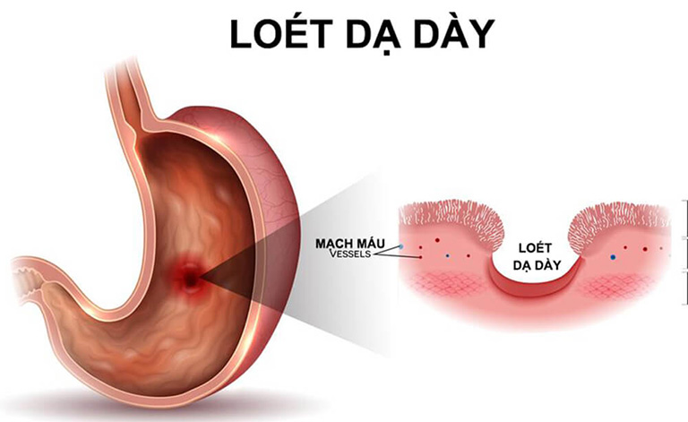 đau bụng dưới mỏ ác