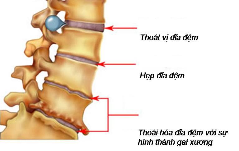 Thoát vị đĩa đệm gây đau vai gáy lan xuống cánh tay