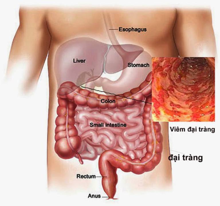 Tình trạng chướng bụng, đầy hơi, ăn uống không tiêu có thể xuất hiện do bệnh lý về tiêu hóa