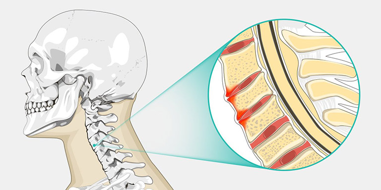 Gai cột sống có chữa được không