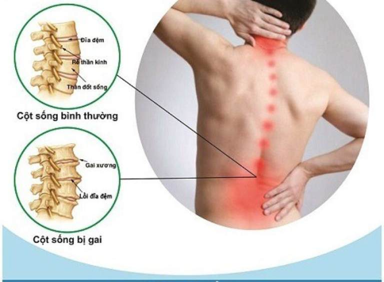 L4 L5 là hai đốt sống nằm ở vị trí thấp nhất của cột sống thắt lưng