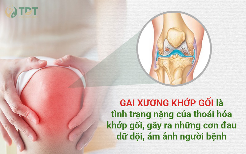 Bệnh gai khớp gối gây đau ám ảnh