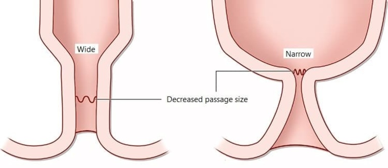 Hậu môn bình thường và hậu môn bị hẹp ở trẻ sơ sinh