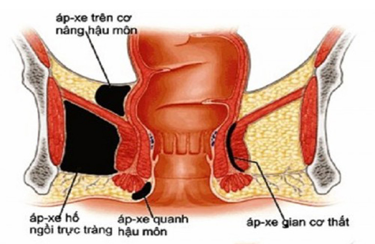 hậu môn tiết dịch nhầy