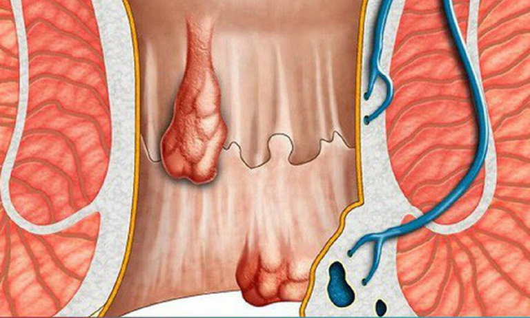 hậu môn chảy dịch hôi