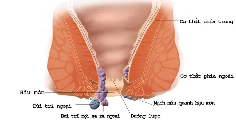 Mô phỏng hậu môn một người bị bệnh trĩ