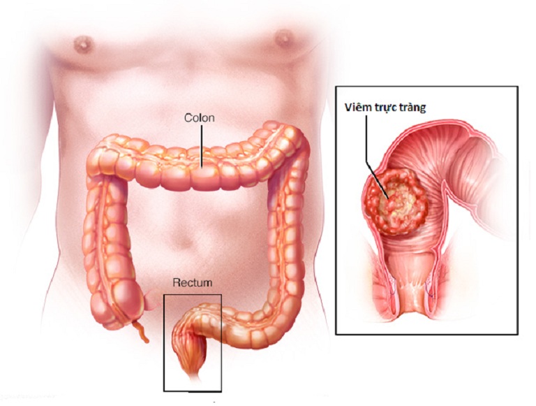 Hậu môn trực tràng