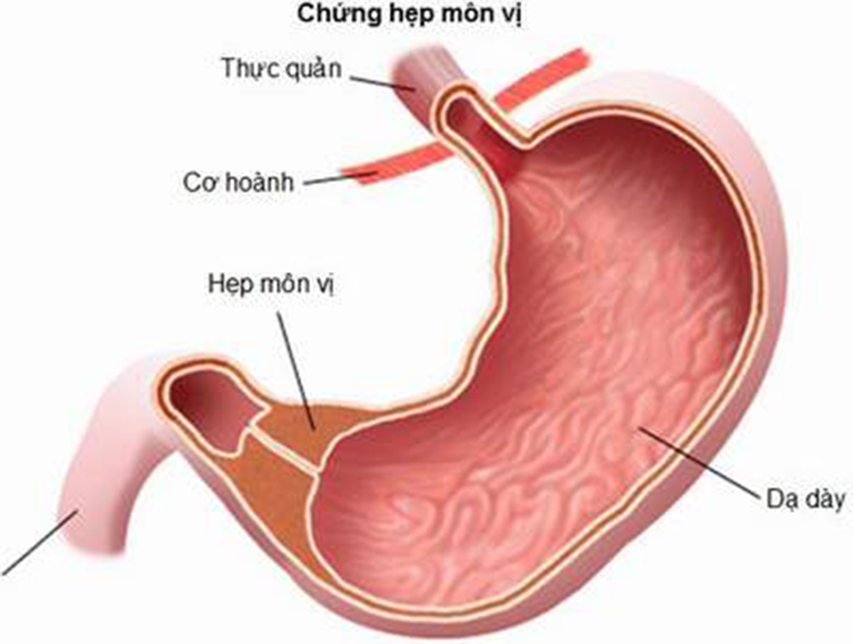 Biến chứng hẹp môn vị dạ dày