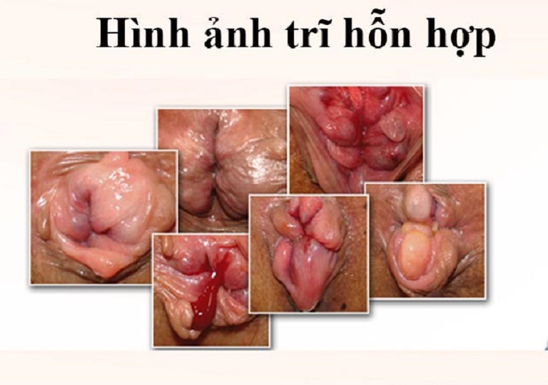 Hình ảnh trĩ hỗn hợp