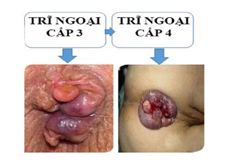 Triệu chứng của bệnh trĩ ngoại