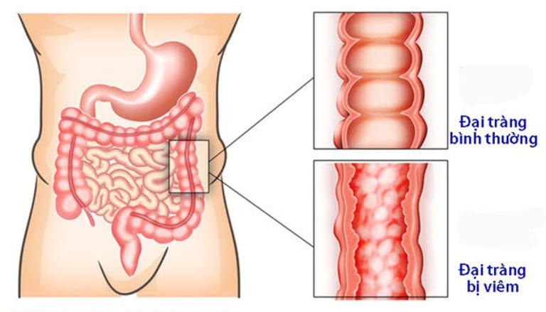 Tình trạng viêm đại tràng xảy ra ở lớp niêm mạc - nơi tiếp xúc trực tiếp với chất thải