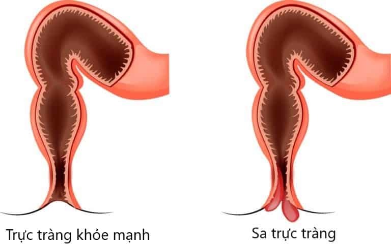 Sa trực tràng thường gặp ở phụ nữ sau khi sinh con. Muốn trực tràng trở về trạng thái bình thường cần phải phẫu thuật