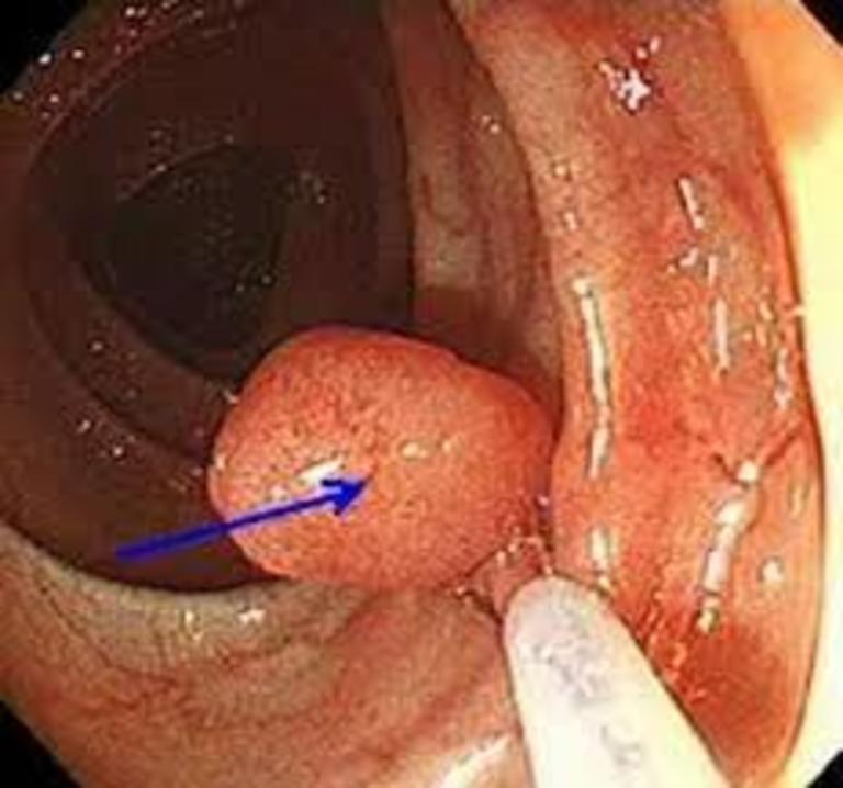 Đa số các trường hợp mắc polyp trực tràng không phát triển thành ung thư