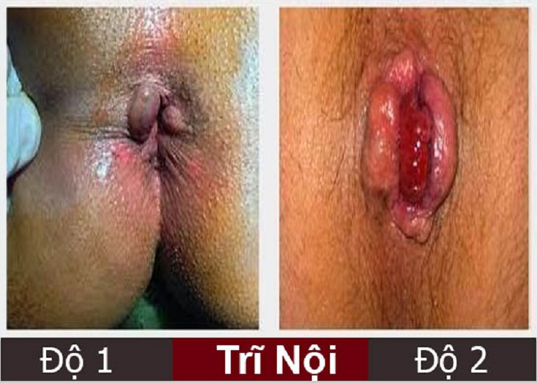 triệu chứng bệnh trĩ nội