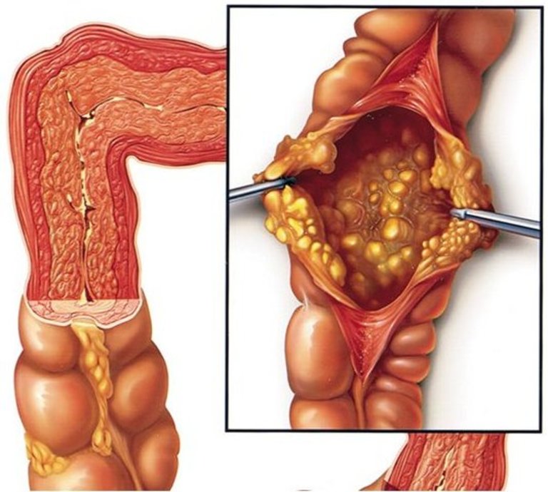 Lạm dụng thuốc kháng sinh có thể gây ra viêm đại tràng giả mạc