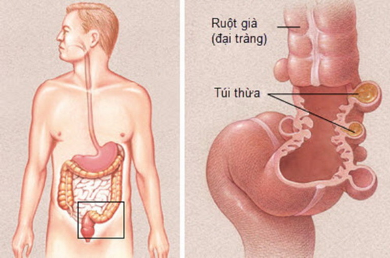 Một trong những nguyên nhân gây bệnh viêm túi thừa đại tràng là tư thế ngồi vệ sinh không đúng