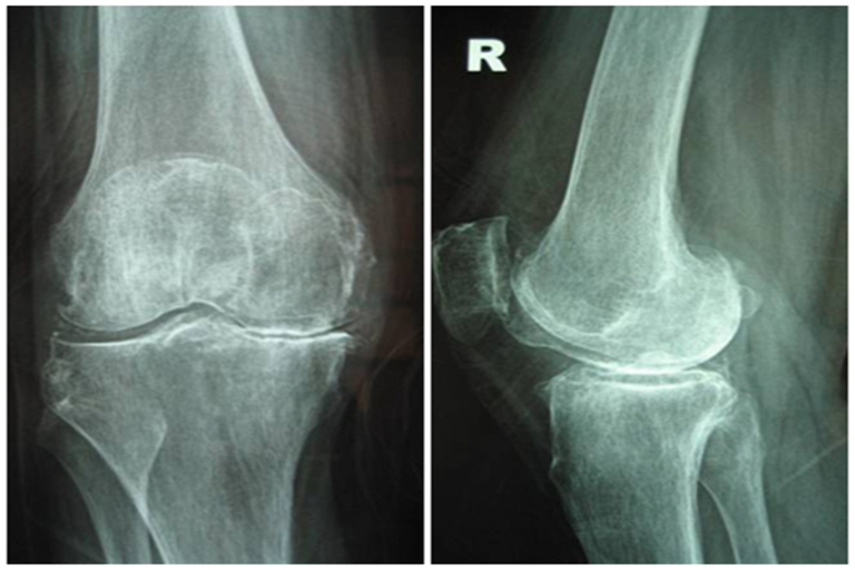 hình ảnh thoái hóa khớp gối