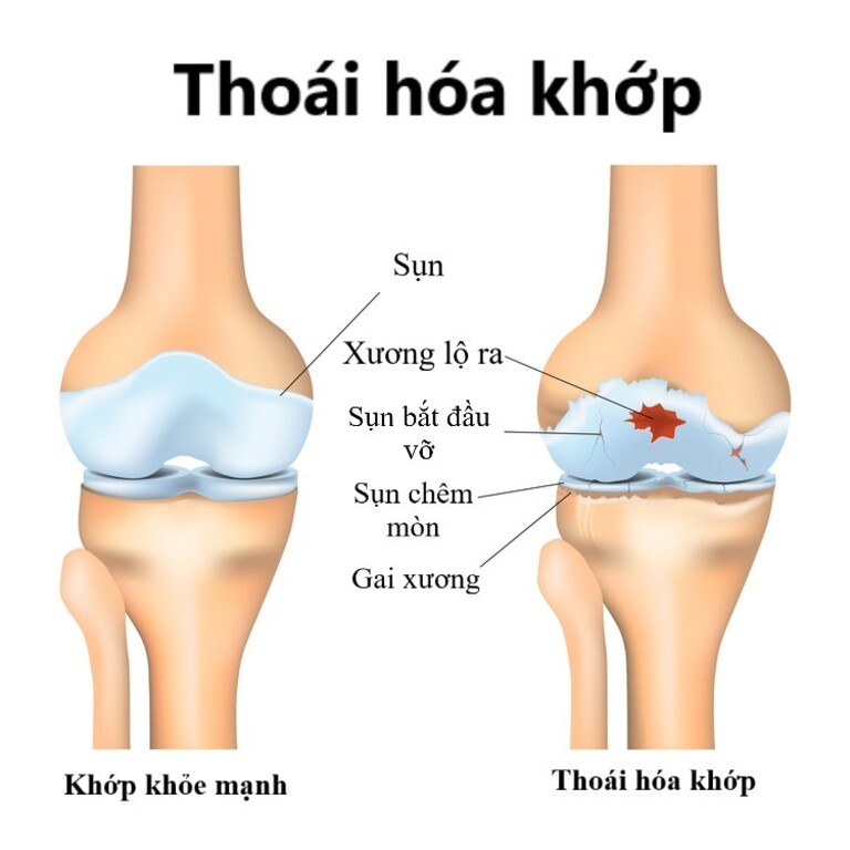 hình ảnh x quang thoái hóa khớp gối