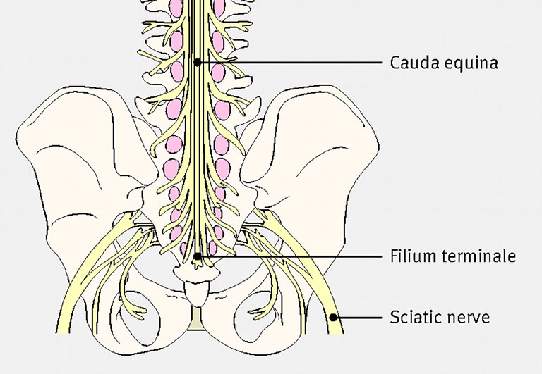 hội chứng chùm đuôi ngựa