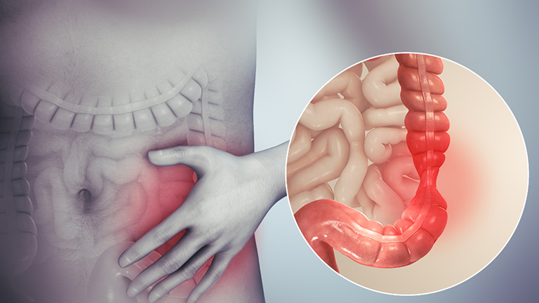 hội chứng ruột kích thích có nguy hiểm không