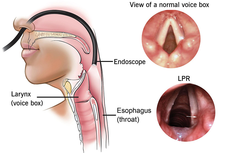 Hội chứng trào ngược họng thanh quản