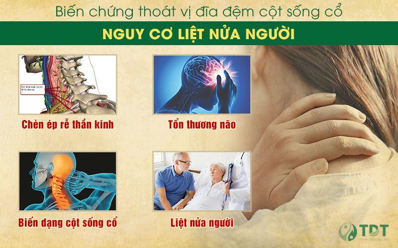 Biến chứng thoát vị đĩa đệm cột sống cổ