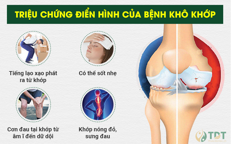 Triệu chứng khô khớp