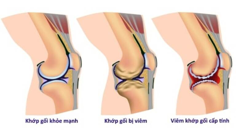 Khớp gối của người bình thường và người bị viêm