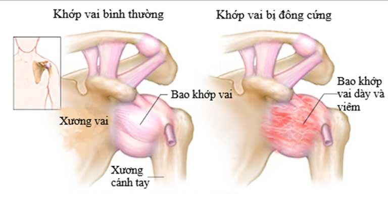 Khớp vai bị đông cứng do bệnh viêm quanh khớp vai