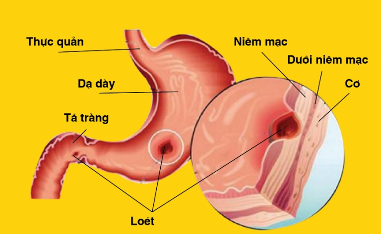 Viêm loét dạ dày là tình trạng niêm mạc dạ dày bị tổn thương dẫn đến loét, viêm.