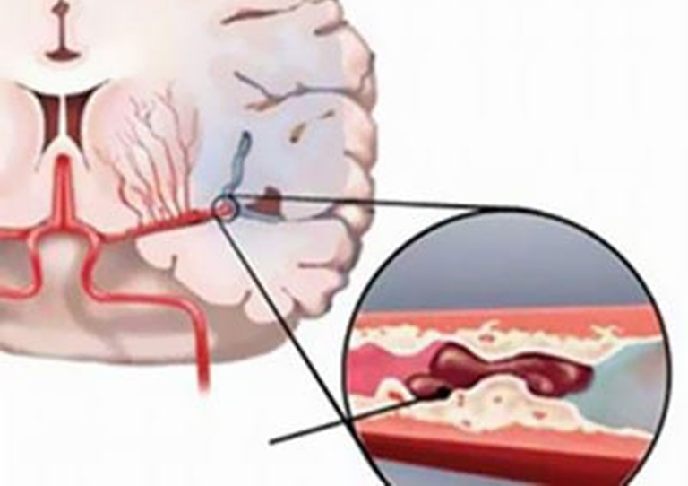 Thoái hóa đốt sống cổ làm giảm lượng máu lưu thông đến não gây ra tình trạng thiếu máu não